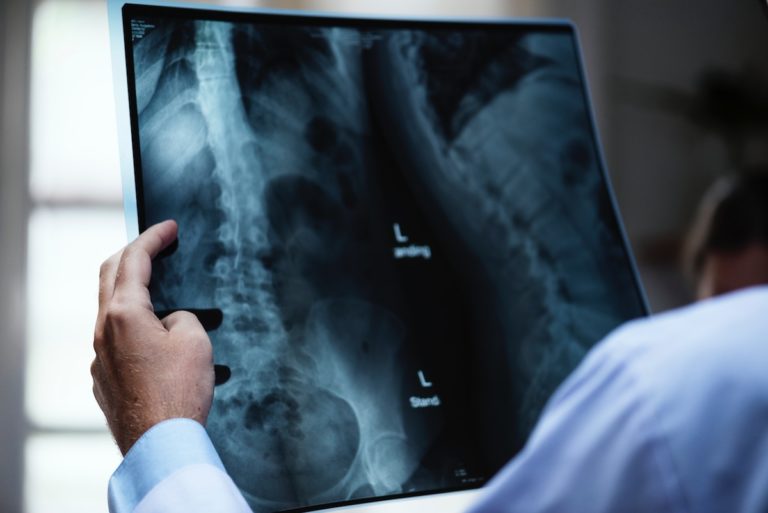 อินเดียวางแผนใช้ AI สแกนผู้มีความเสี่ยงวัณโรคจากภาพ X-Ray อาจเพิ่มประสิทธิผลในการตรวจได้ 3 เท่า